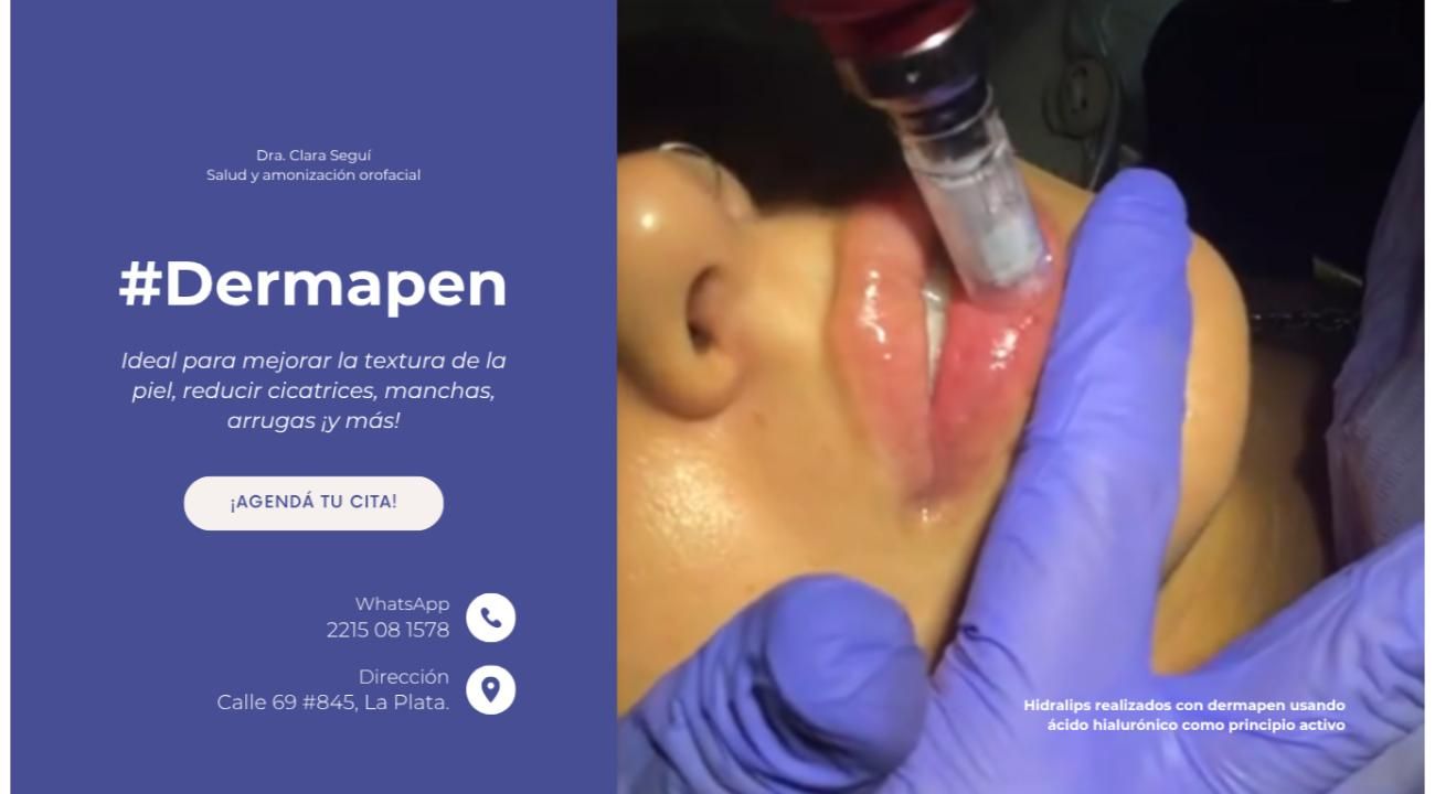 El Dermapen en los tratamientos de armonización orofacial: una revolución en el cuidado de la piel