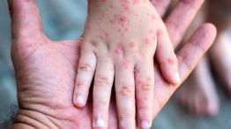 Crece el alerta por los brotes de sarampión.
