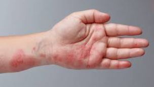 Con el frío se agravan los casos de dermatitis 