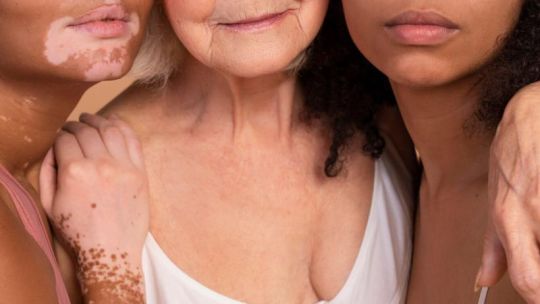Día Mundial del Vitiligo: el impacto psicológico de una enfermedad que va más allá de la piel