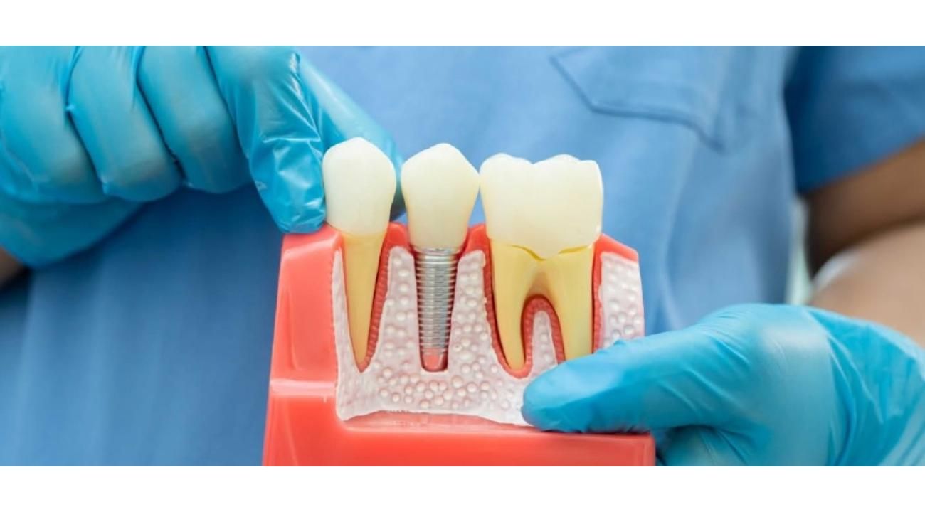 Implates Dentales: la solución definitiva a la falta de piezas dentales.