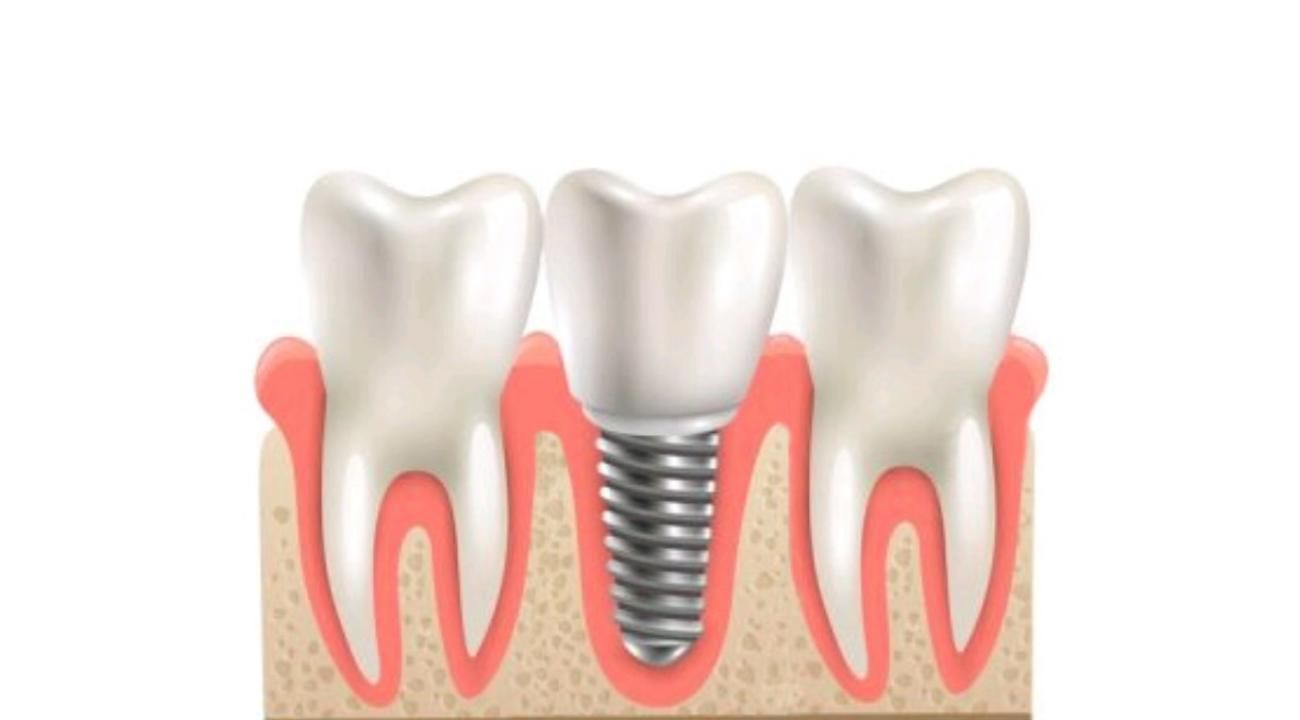 Implates Dentales: la solución definitiva a la falta de piezas dentales.