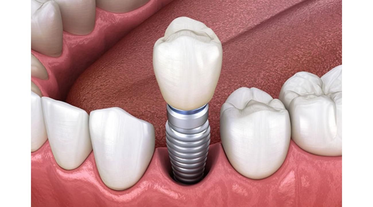 Implates Dentales: la solución definitiva a la falta de piezas dentales.