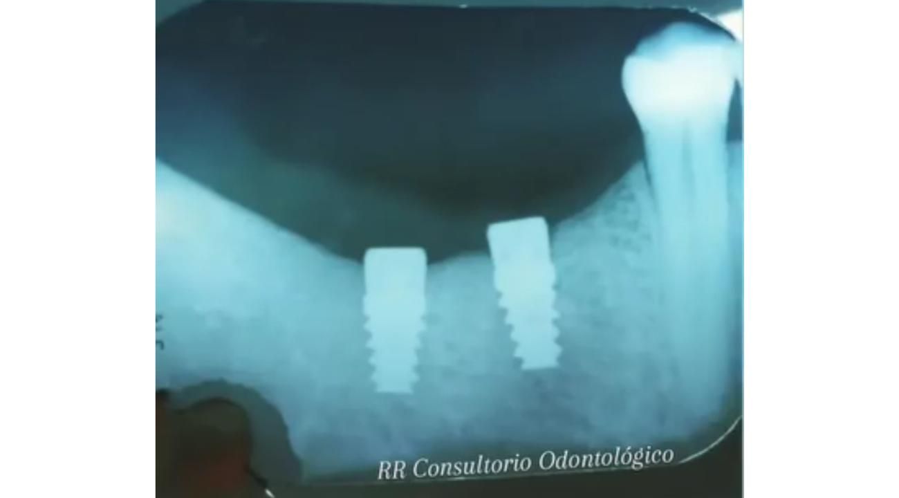 Implates Dentales: la solución definitiva a la falta de piezas dentales.