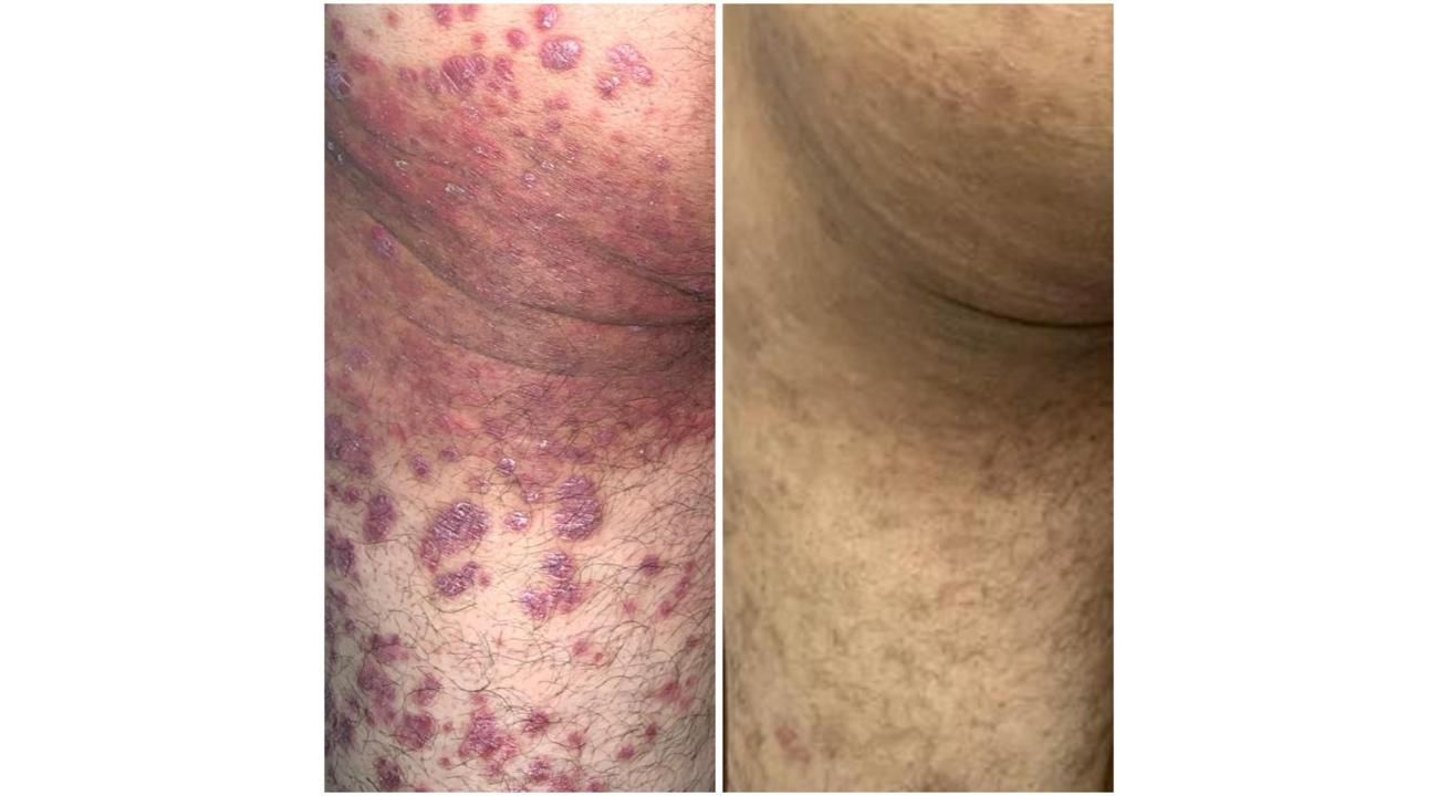 Psoriasis: un desafío terapéutico