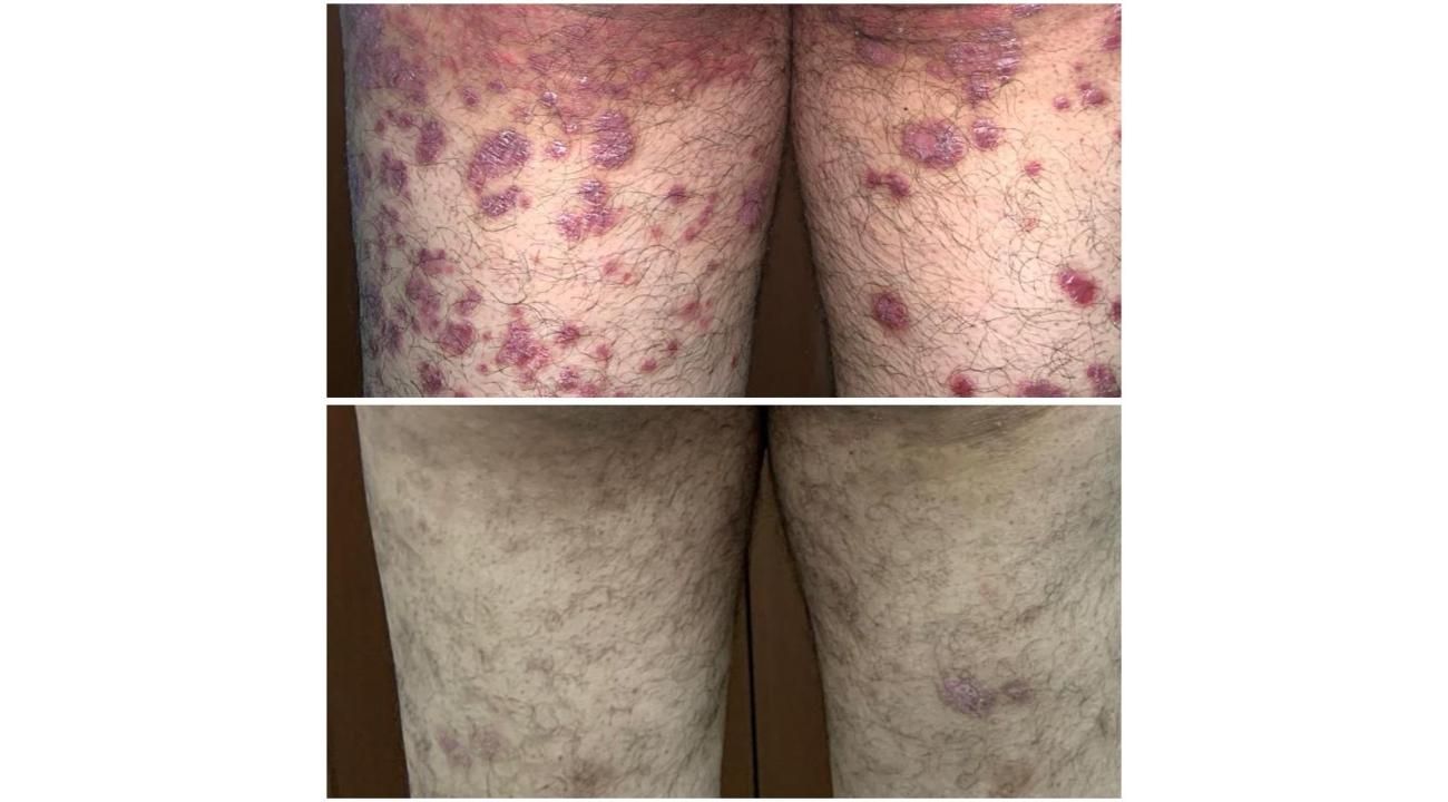 Psoriasis: un desafío terapéutico