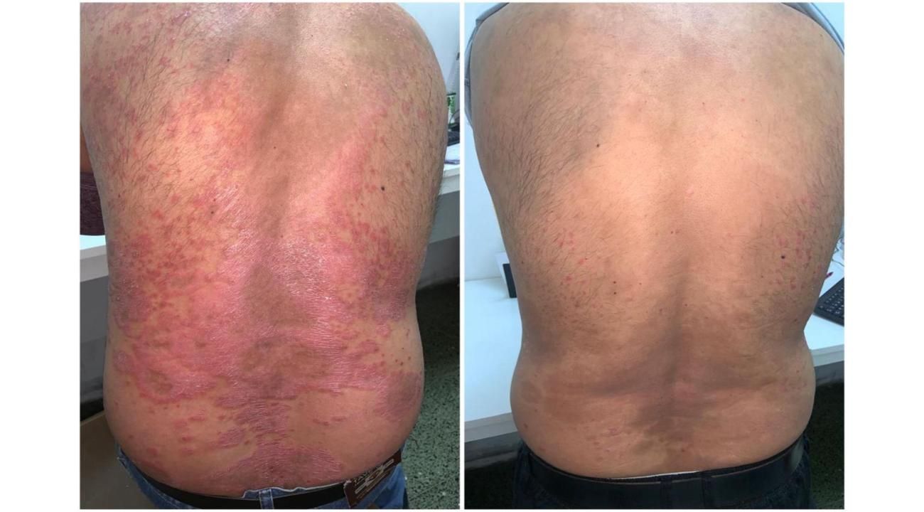 Psoriasis: un desafío terapéutico