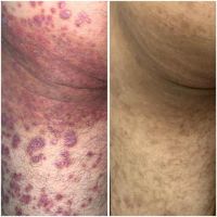 Psoriasis: un desafío terapéutico