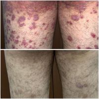 Psoriasis: un desafío terapéutico