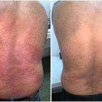 Psoriasis: un desafío terapéutico