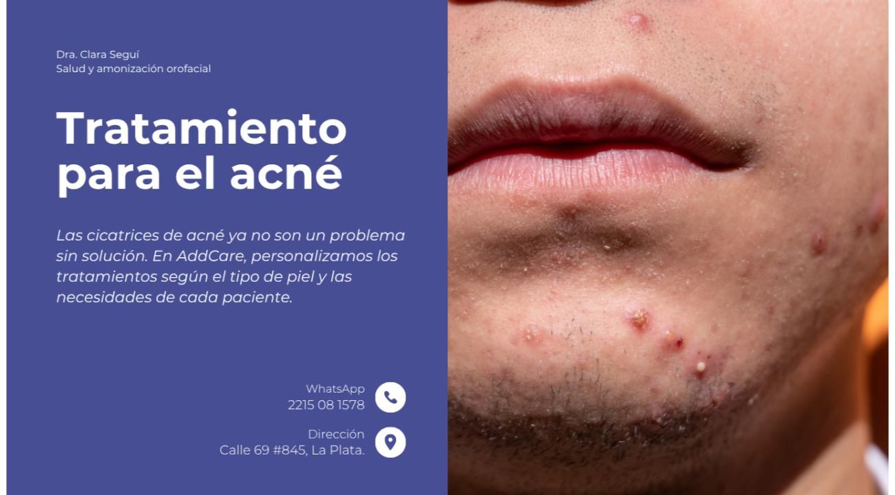 Cicatrices de acné: causas y tratamientos innovadores para recuperar la piel