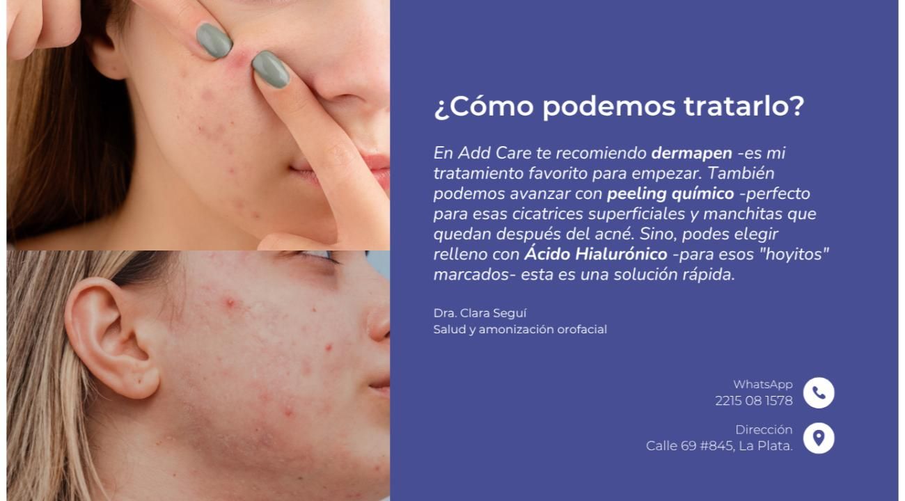Cicatrices de acné: causas y tratamientos innovadores para recuperar la piel