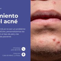 Cicatrices de acné: causas y tratamientos innovadores para recuperar la piel