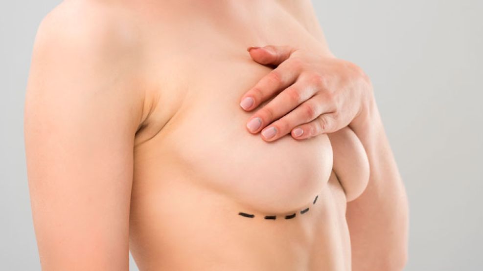 explante-protesis-mamarias-1