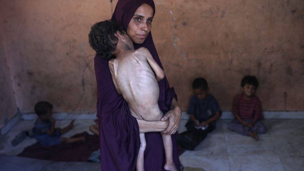 Desnutrición en Gaza 24072025