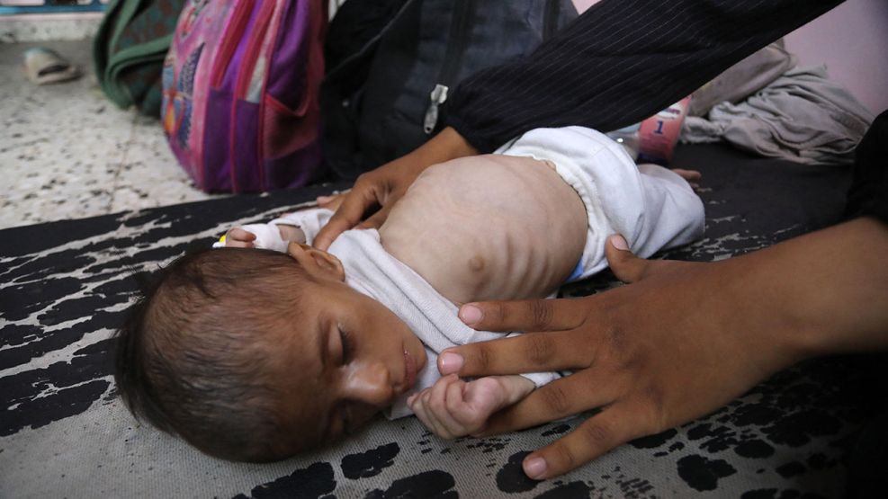 Desnutrición en Gaza 24072025