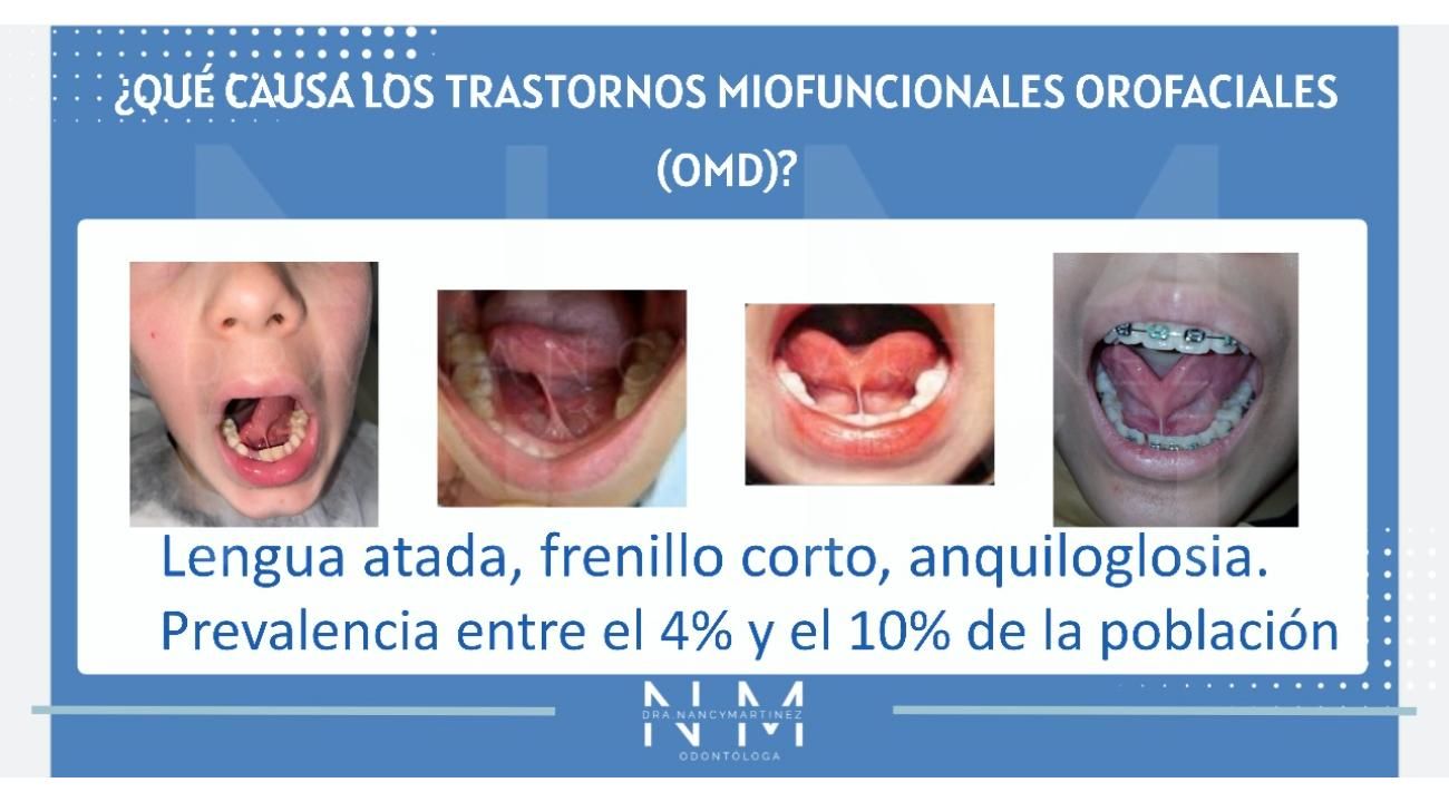 Dra. Nancy Martinez: Tratamiento en forma precoz de un frenillo lingual corto 