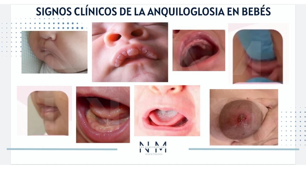 Dra. Nancy Martinez: Tratamiento en forma precoz de un frenillo lingual corto 