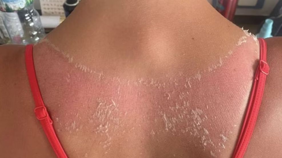 Usó un top de Shein y sufrió graves quemaduras.