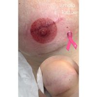 MICROPIGMENTACIÓN DE AREOLAS