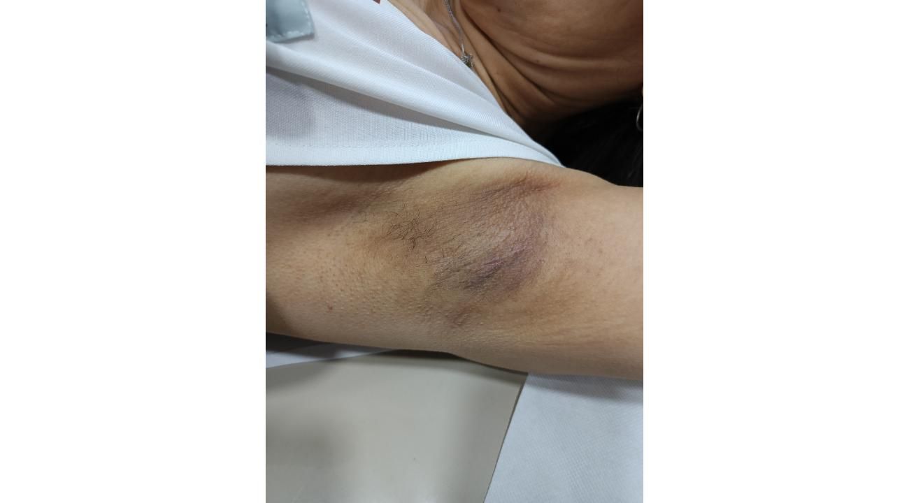 Melasma, el desafio dermatológico de la Hiperpigmentacion