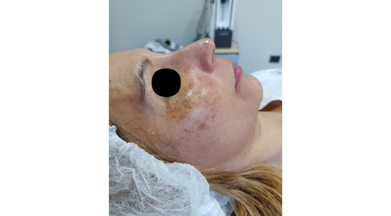 Melasma, el desafio dermatológico de la Hiperpigmentacion