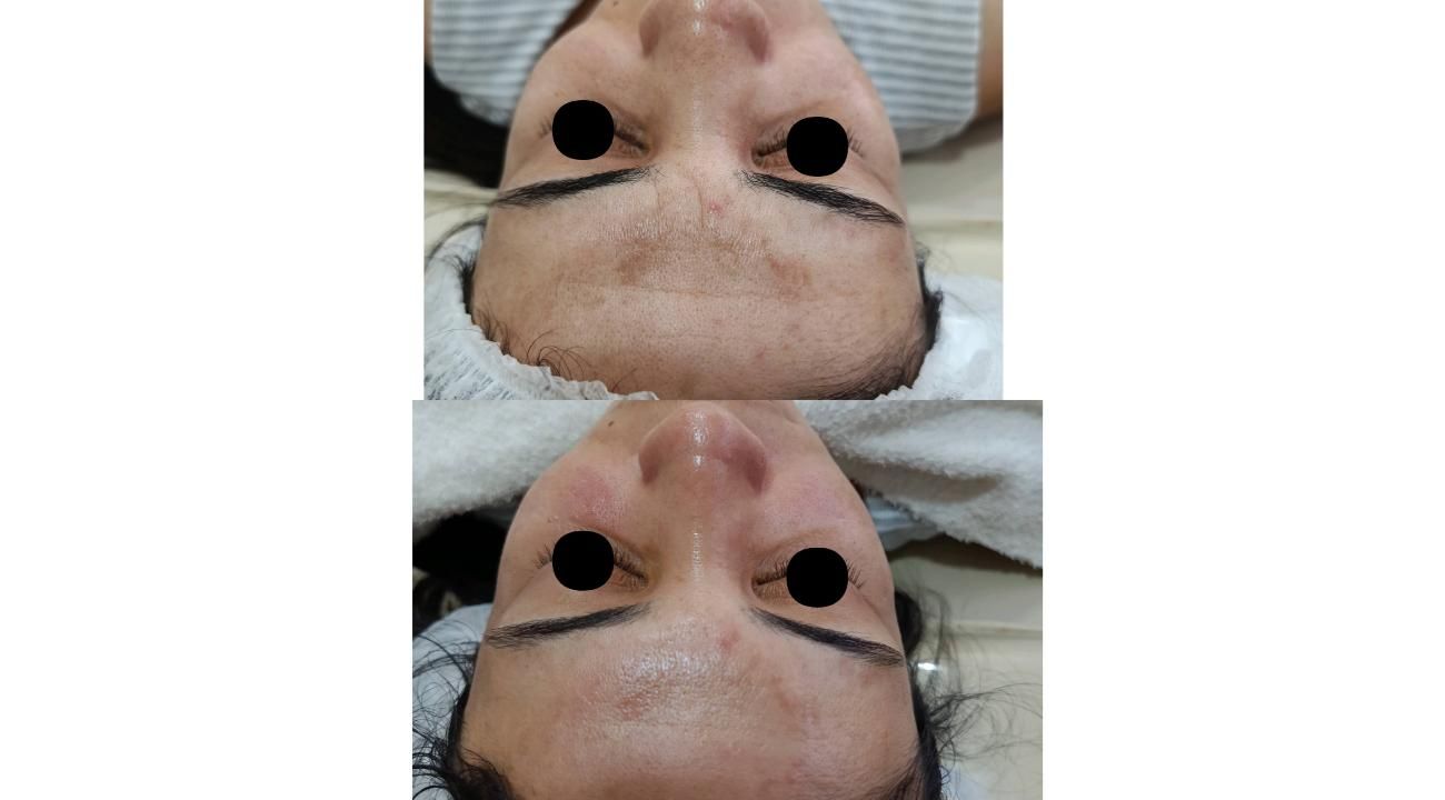 Melasma, el desafio dermatológico de la Hiperpigmentacion