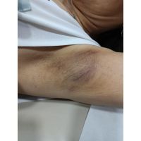 Melasma, el desafio dermatológico de la Hiperpigmentacion
