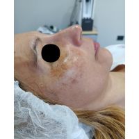 Melasma, el desafio dermatológico de la Hiperpigmentacion