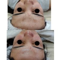 Melasma, el desafio dermatológico de la Hiperpigmentacion