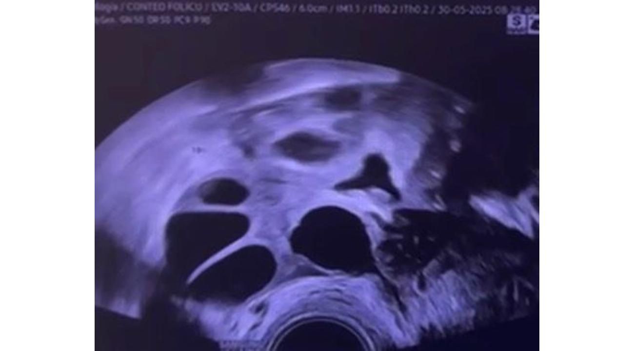 De la presión al control: cómo congelar óvulos te devuelve la tranquilidad