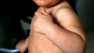 Crece la preocupación en América por los brotes de sarampión.