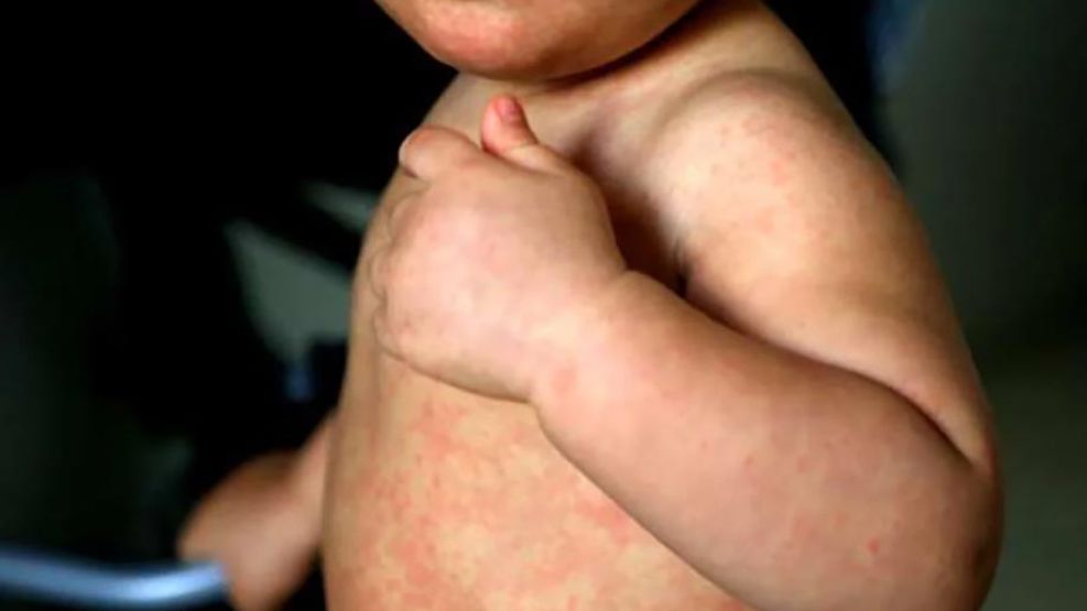 Crece la preocupación en América por los brotes de sarampión.