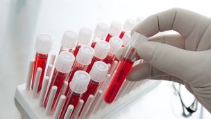 Un análisis de sangre podría detectar la demencia. 