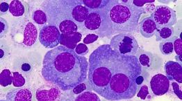 Mieloma multiple 13112025