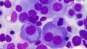 Mieloma multiple 13112025