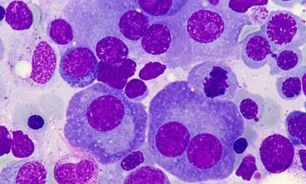 Mieloma multiple 13112025