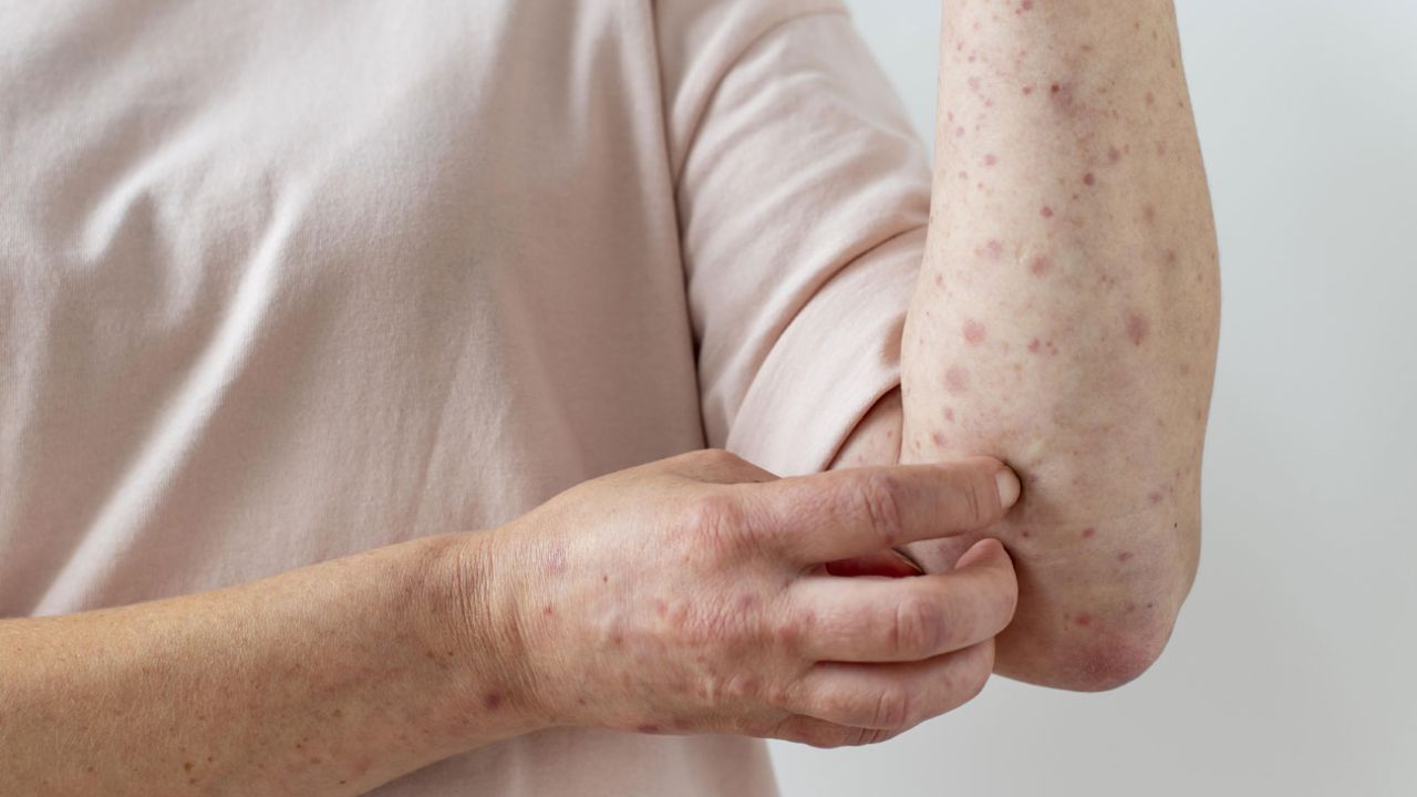 Atención sanitaria y vacunación contra el sarampión