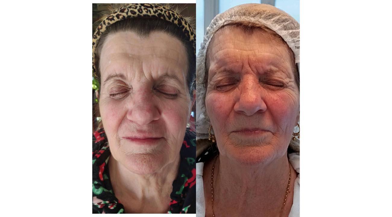 El poder de la Armonización Facial