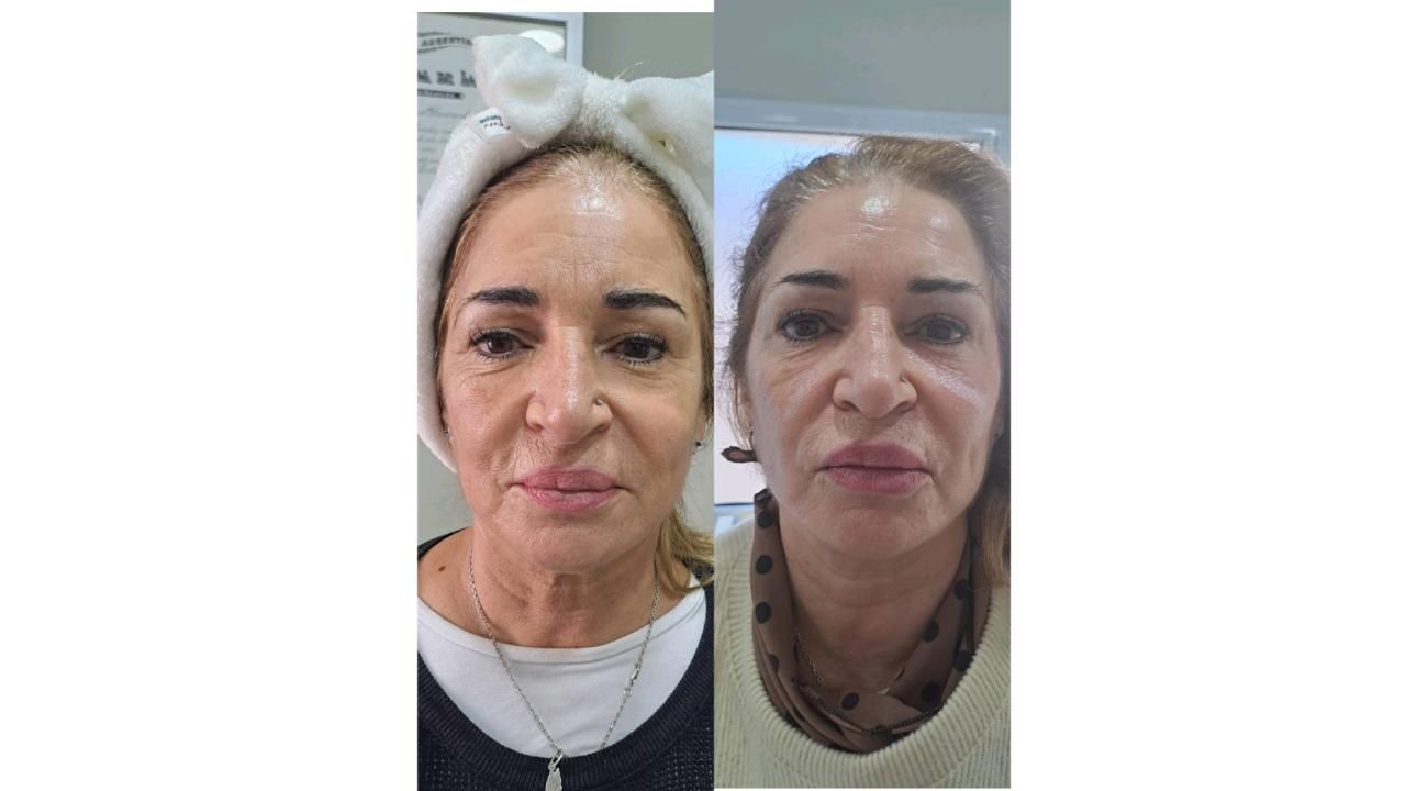El poder de la Armonización Facial
