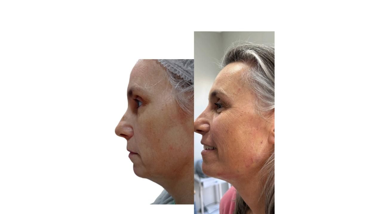 El poder de la Armonización Facial