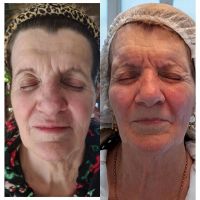 El poder de la Armonización Facial