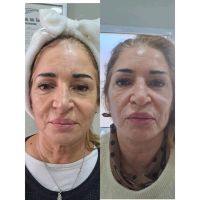 El poder de la Armonización Facial
