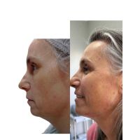 El poder de la Armonización Facial