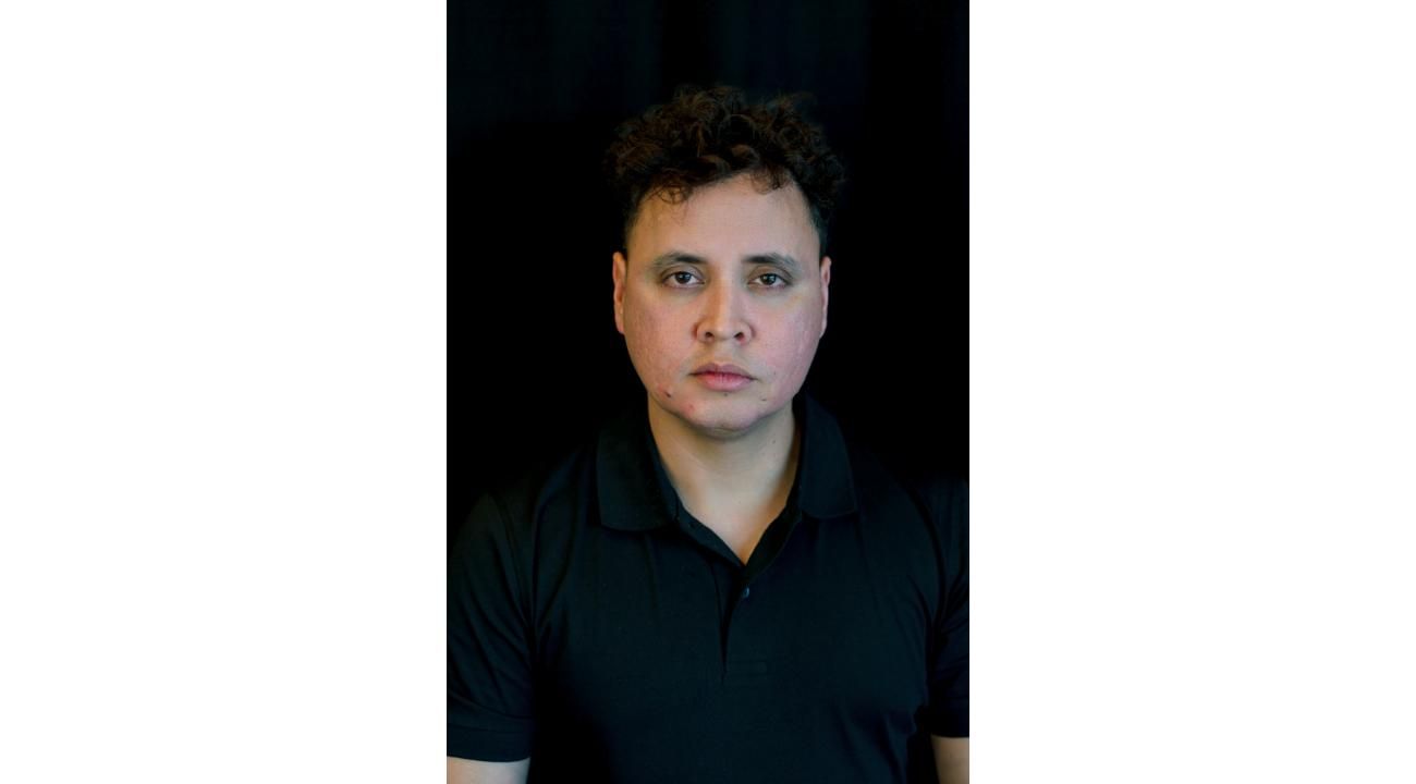 ¿Cuánto dura el relleno del contorno mandibular?