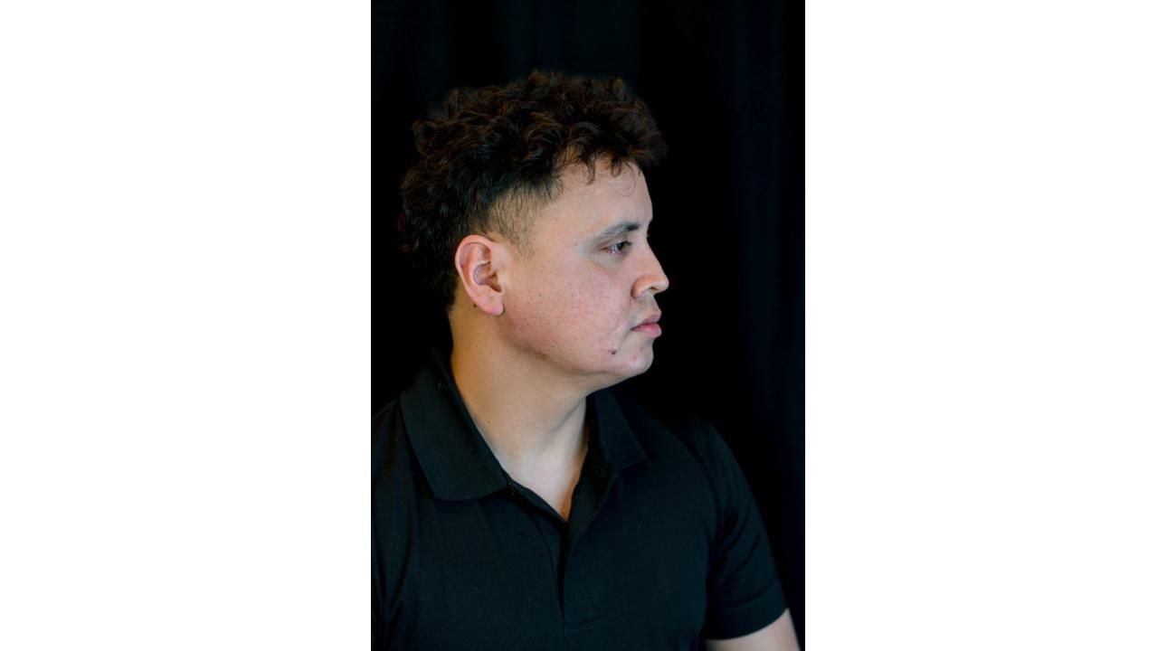 ¿Cuánto dura el relleno del contorno mandibular?