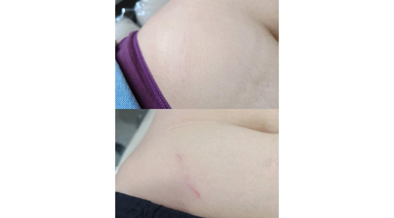 Estrías, cómo prevenir y tratar las huellas que deja en la piel         