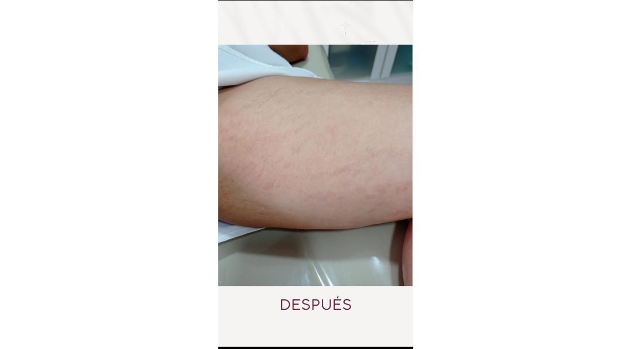 Estrías, cómo prevenir y tratar las huellas que deja en la piel         