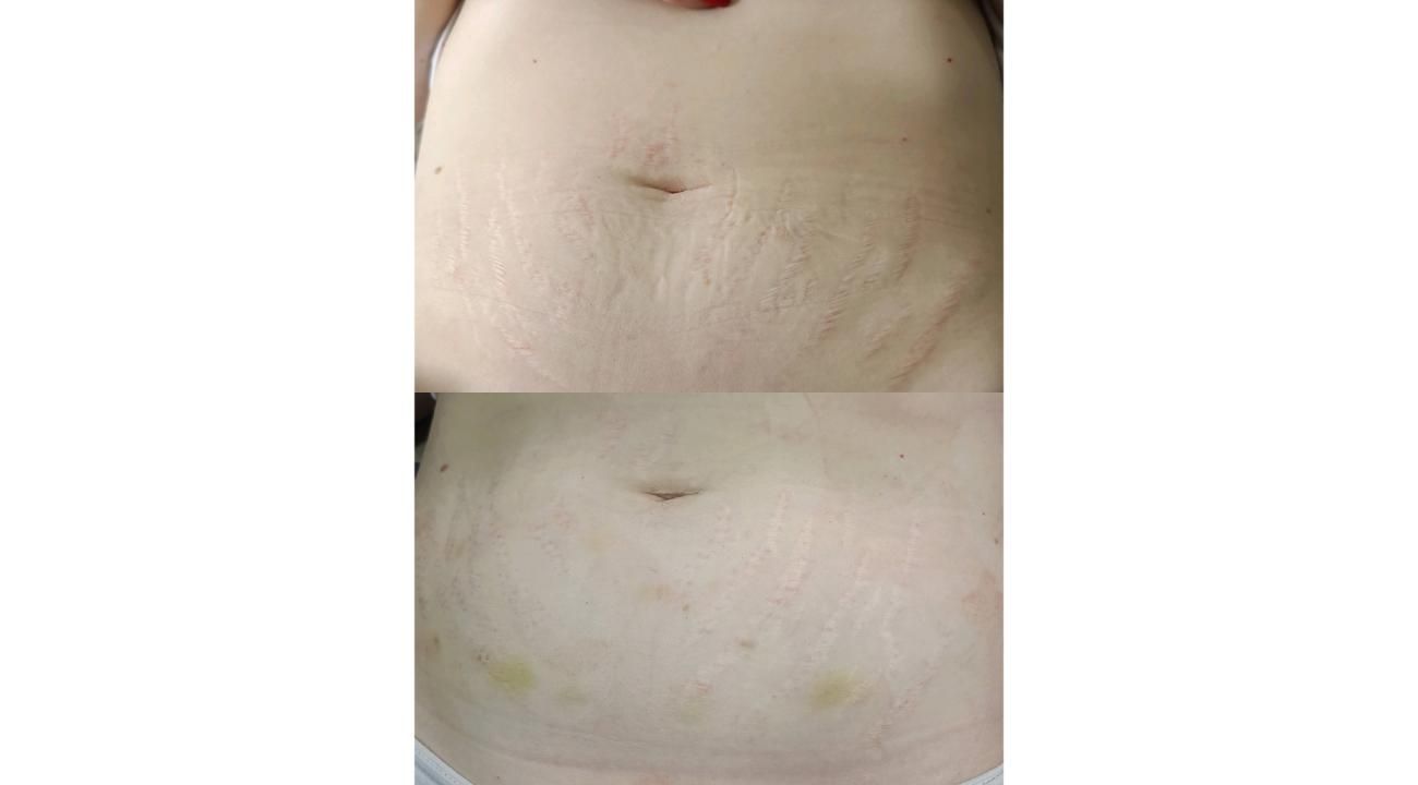 Estrías, cómo prevenir y tratar las huellas que deja en la piel         