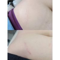 Estrías, cómo prevenir y tratar las huellas que deja en la piel         